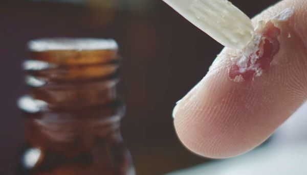 اسید سالیسیلیک برای درمان زگیل